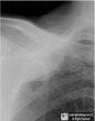 Pleural Lipoma